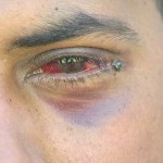 Taxi driver Manbir Singh lost the sight in his left eye