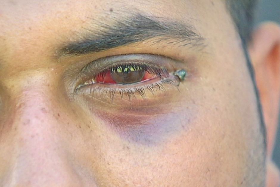 Taxi driver Manbir Singh lost the sight in his left eye